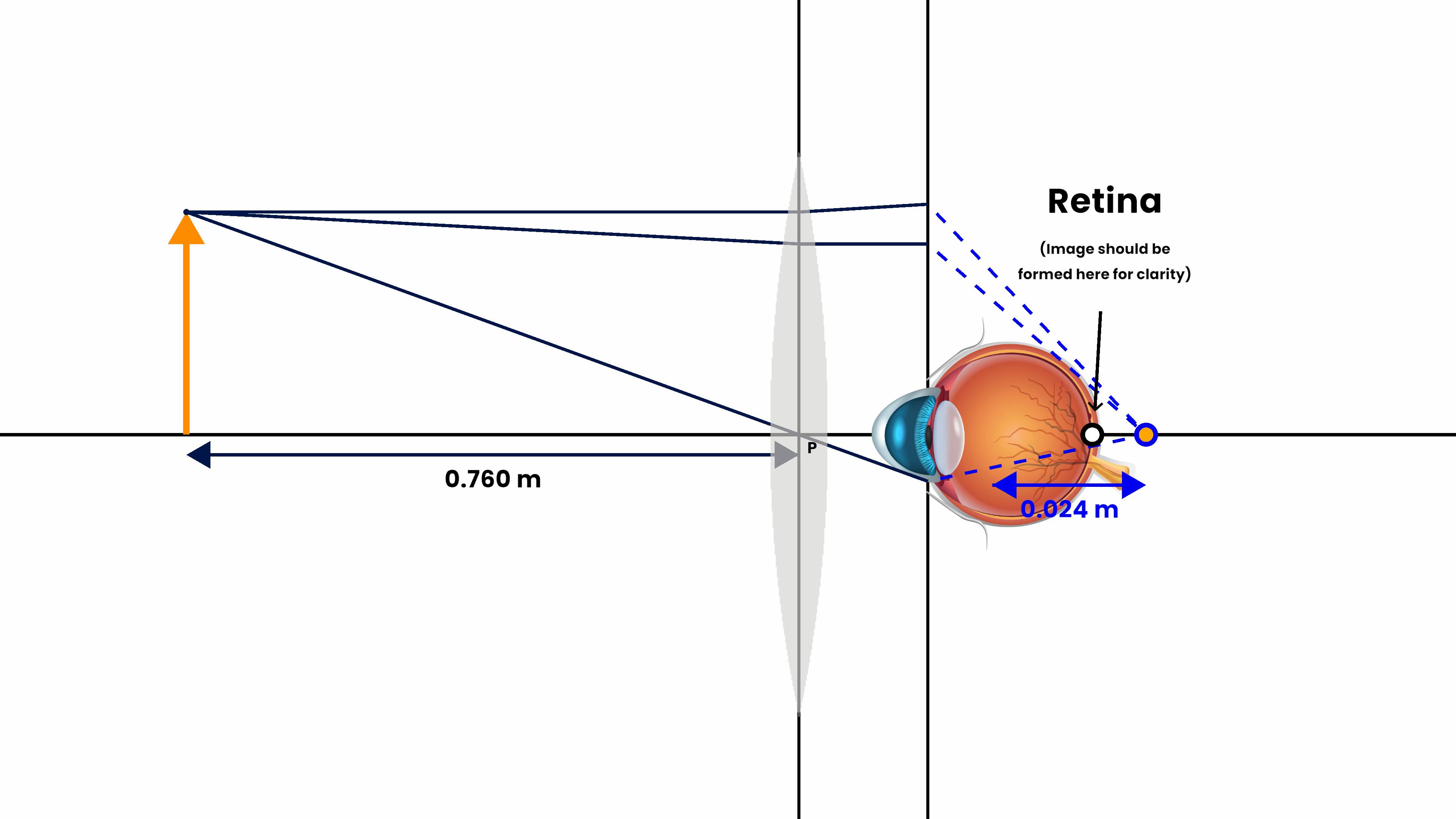 Eye defect (Hypermetropia-Farsightedness)